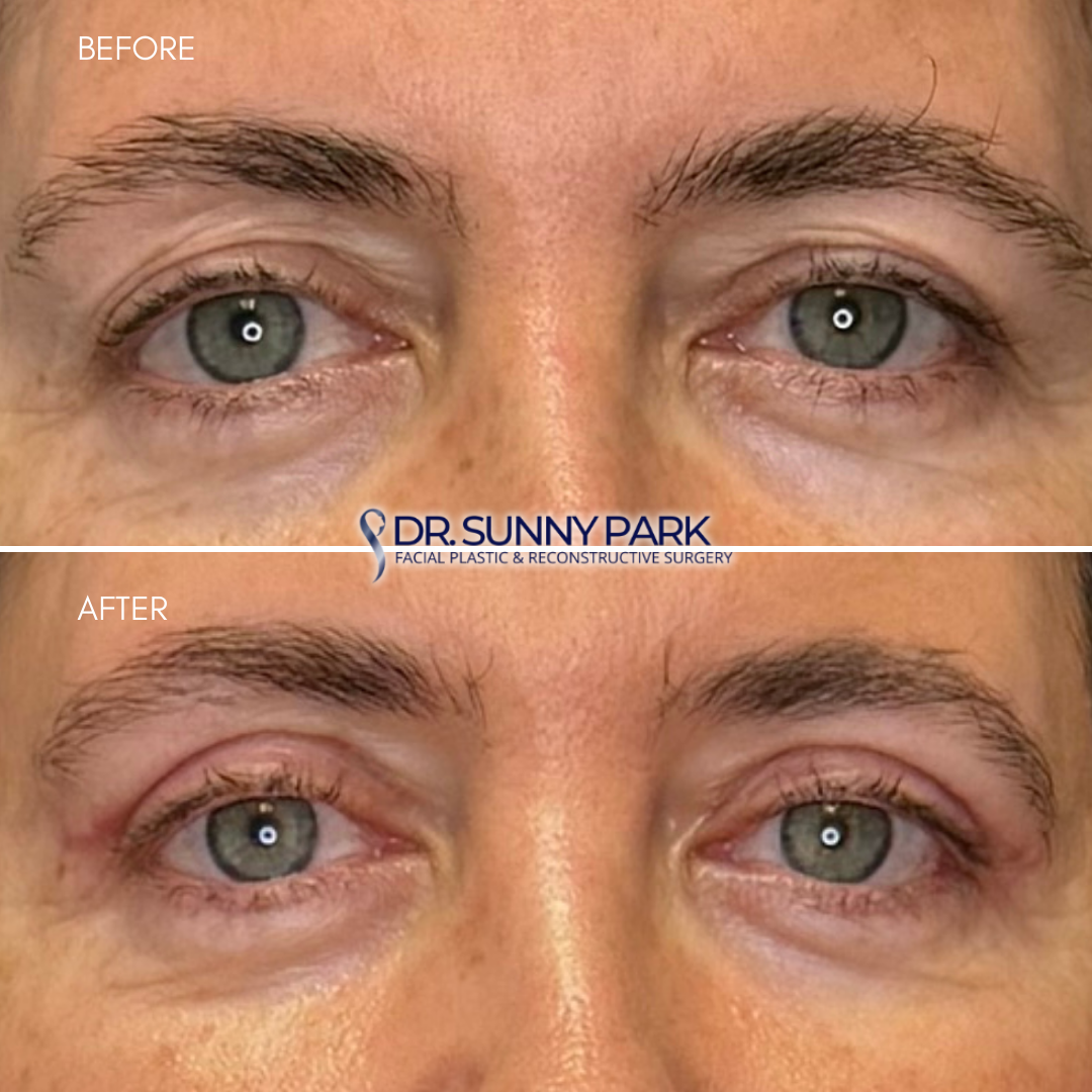 Upper blepharoplasty