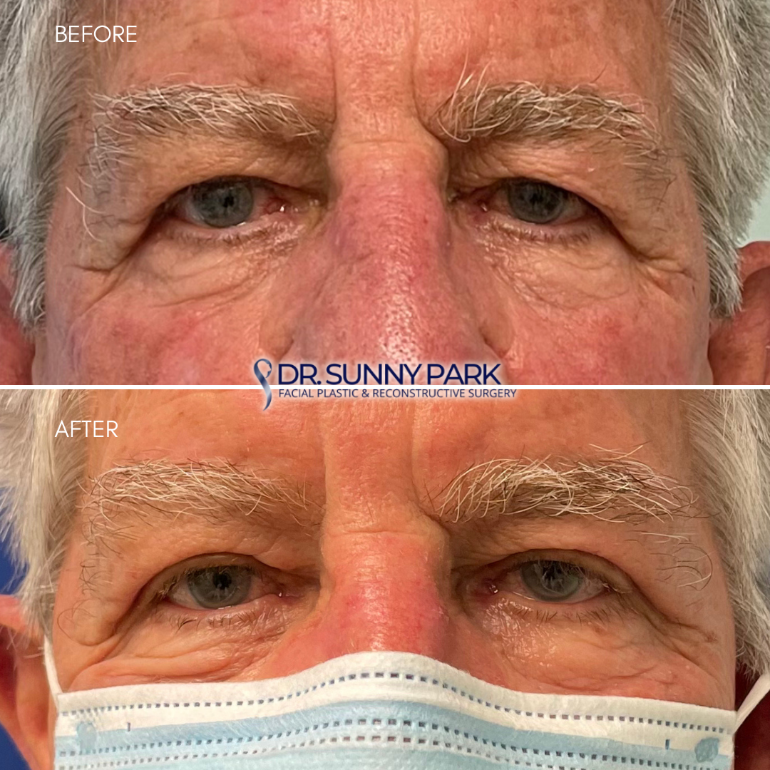 Upper blepharoplasty