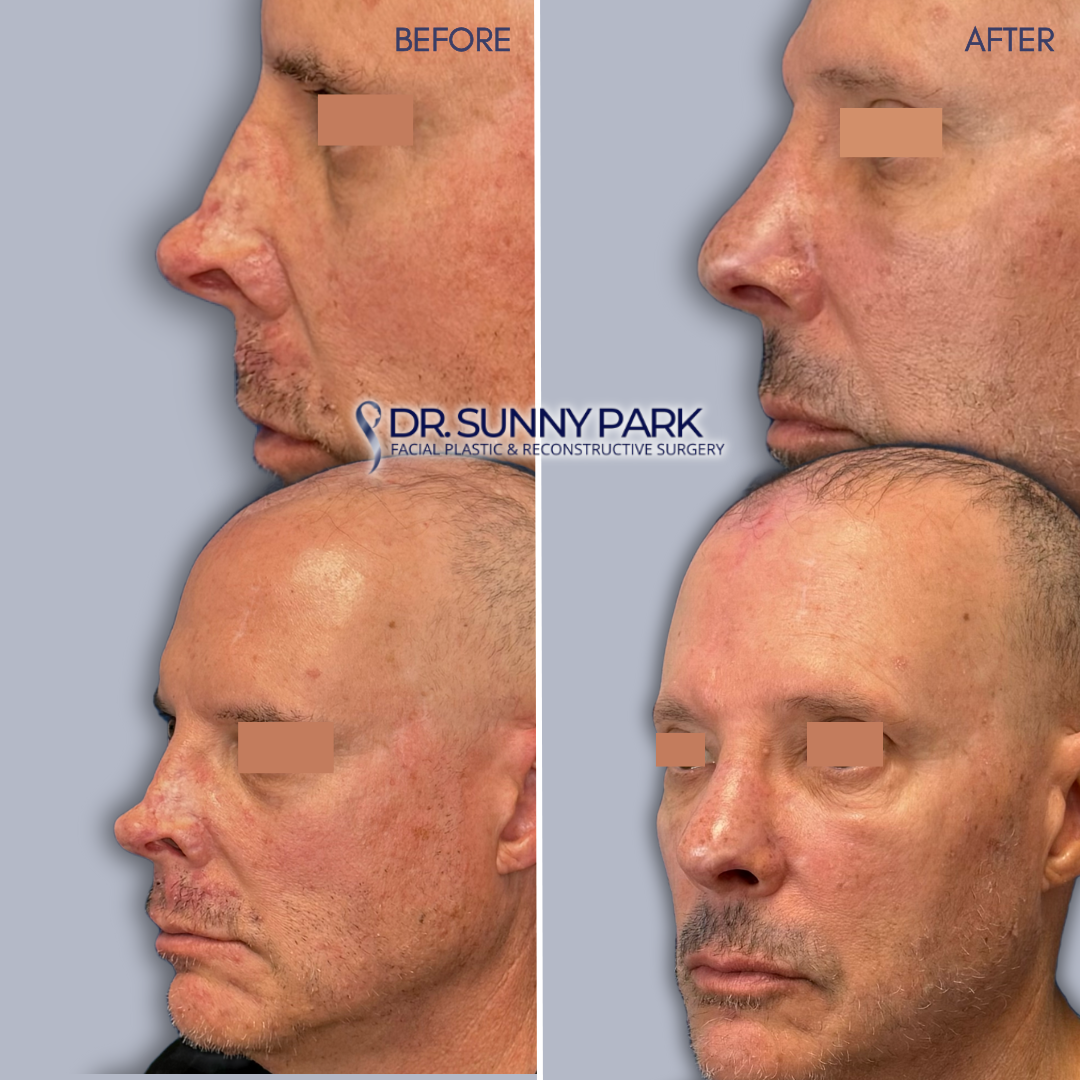 Reults of Forehead Flap Following Skin Cancer Removal