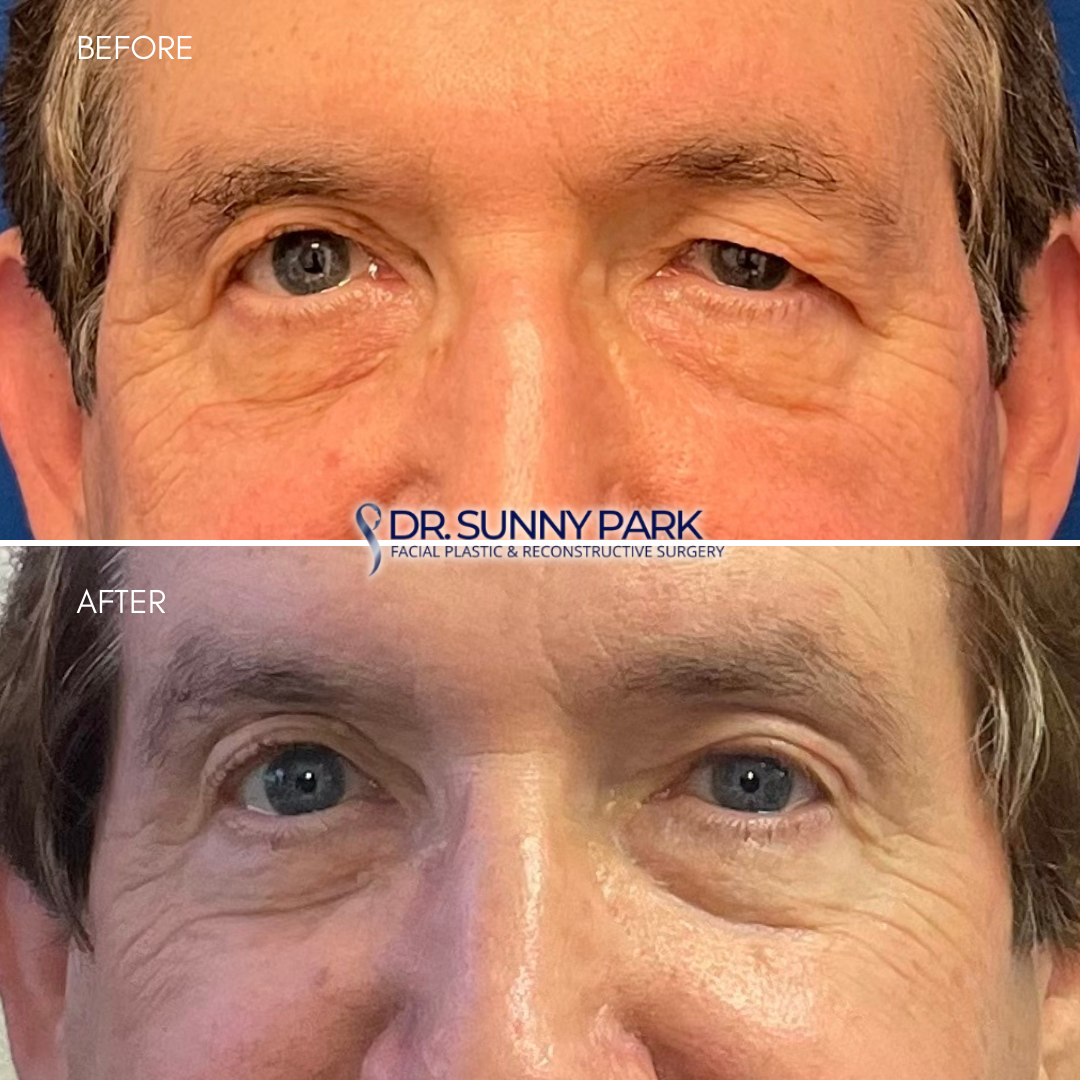 Left upper blepharoplasty for asymmetric eyelids.