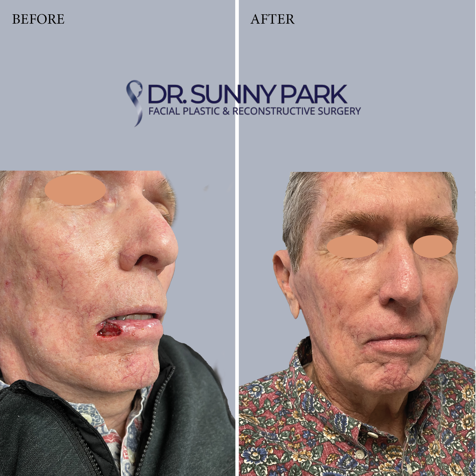 Reconstruction of the lower lip following excision of basal cell carcinoma.