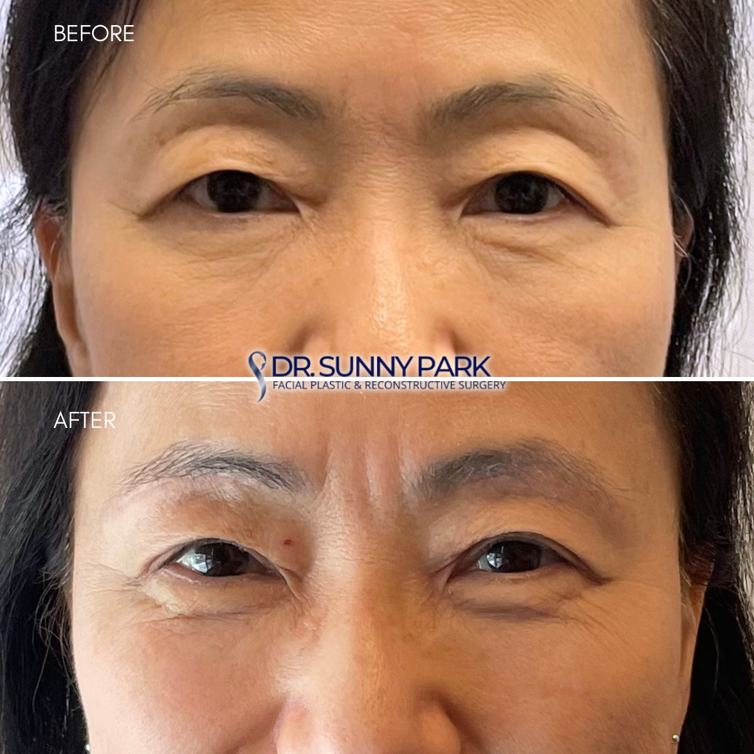  infrabrow blepharoplasty: creates a surgical incision at the lower eyebrow rather than the eyelid, maintaining the natural shape of the crease.  