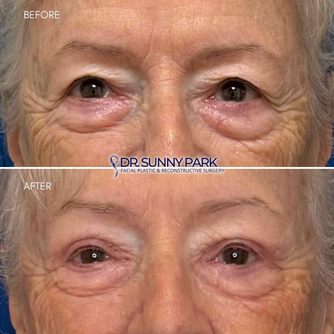 Upper Blepharoplasty