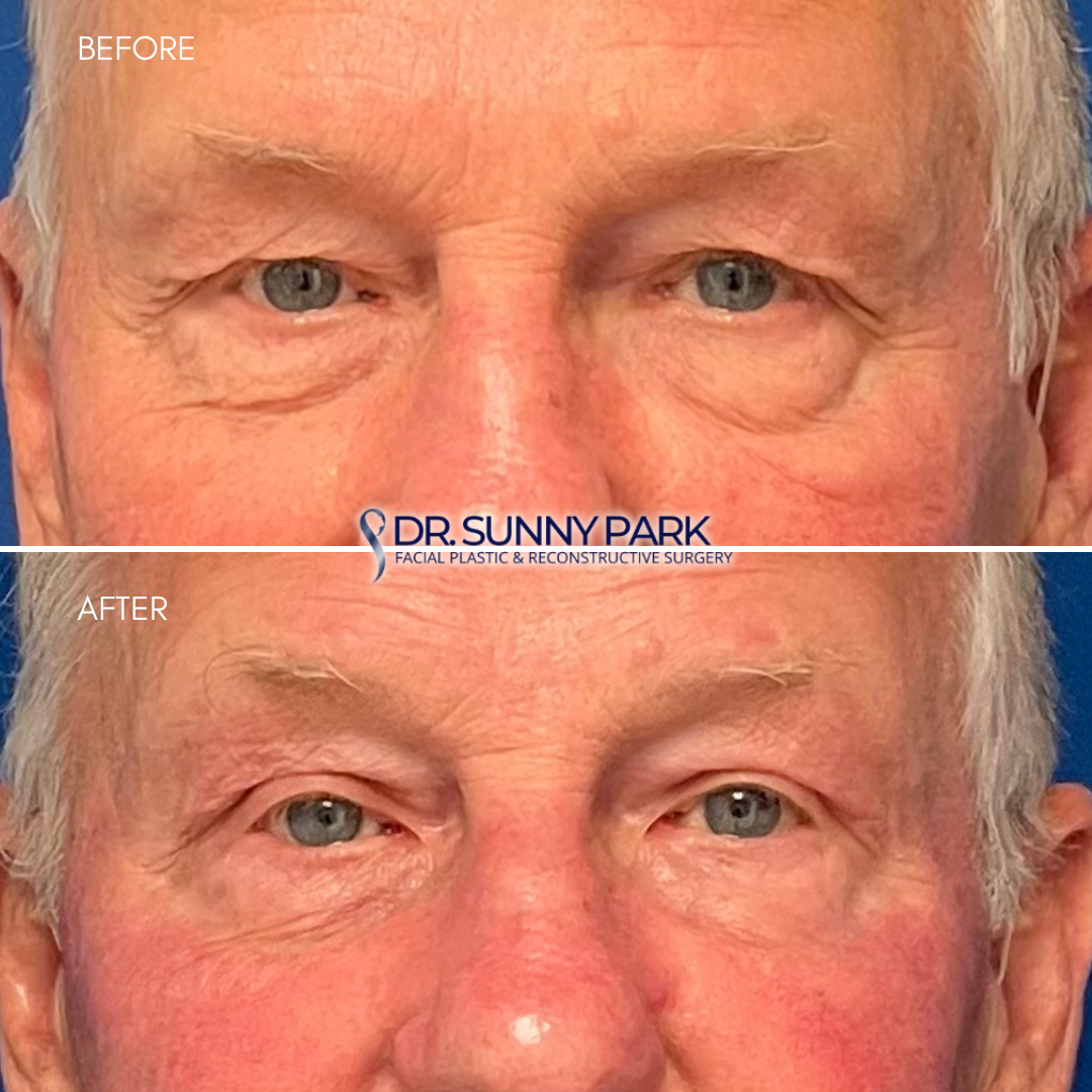 Upper Blepharoplasty. 