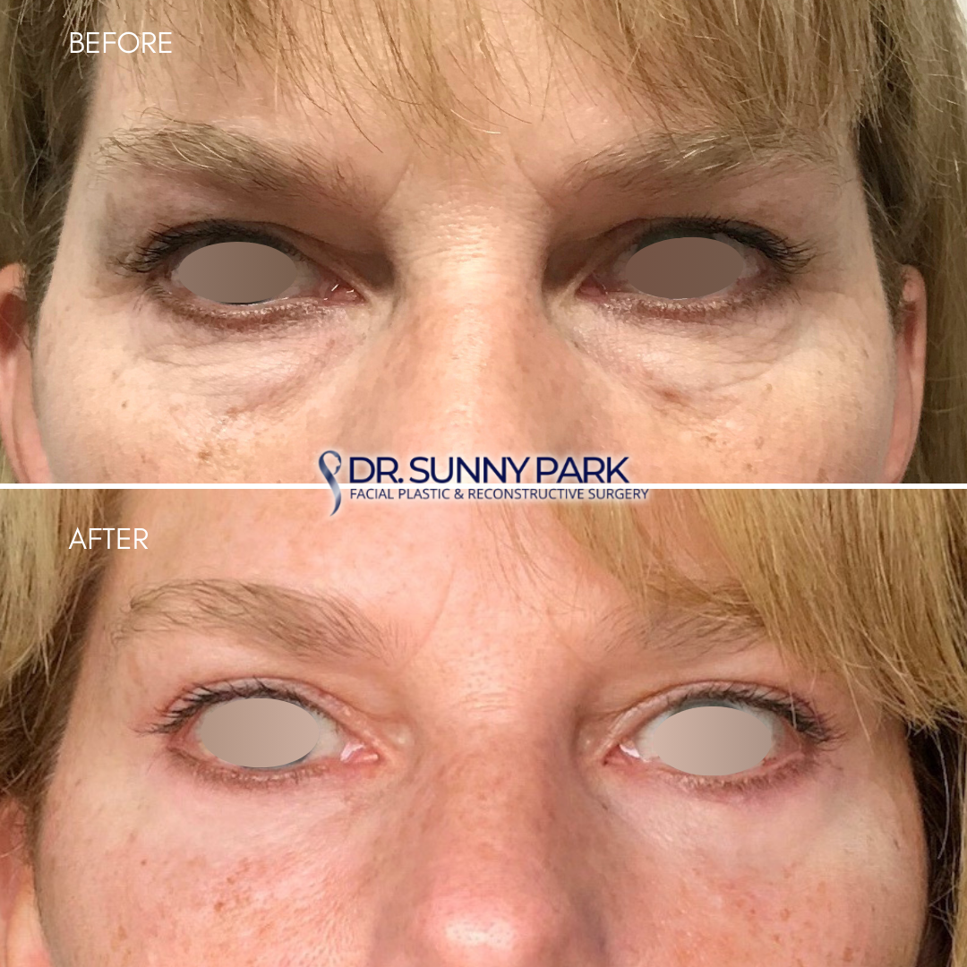 Upper and lower blepharoplasty