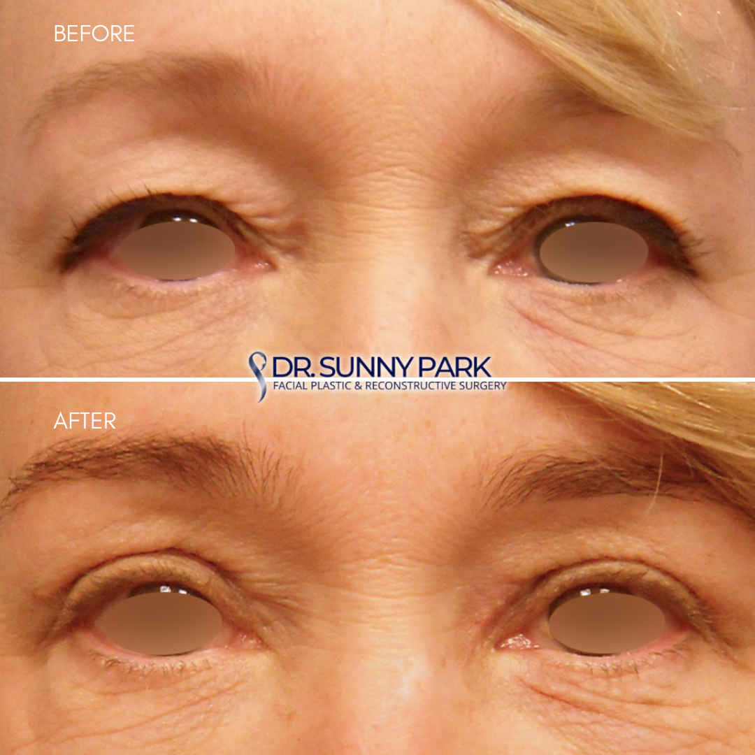 Upper Blepharoplasty