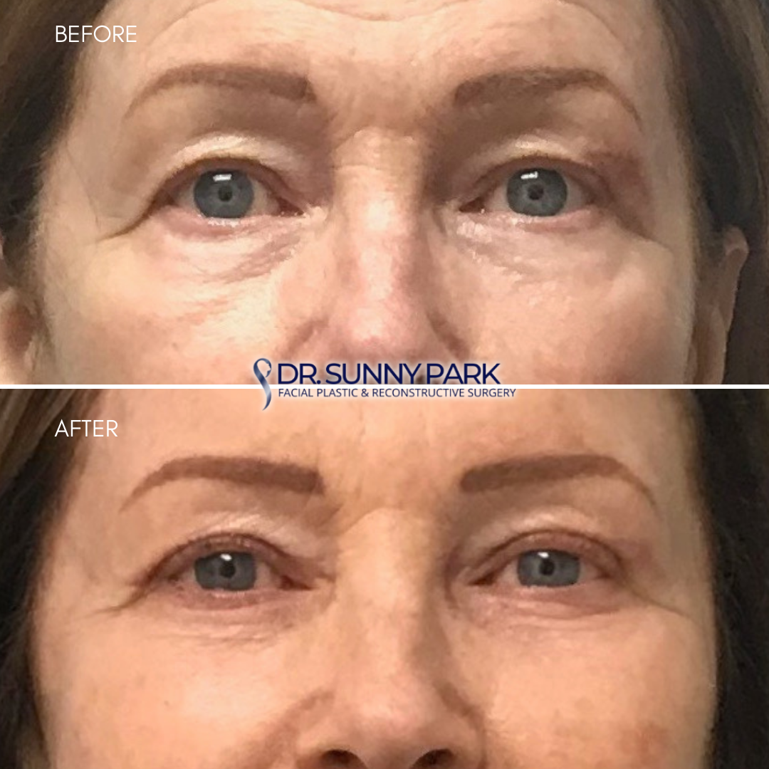 Patient in the before picture is raising her eyebrows to physically "lift" excess upper eyelid skin. Patient in the after picture is at rest. 