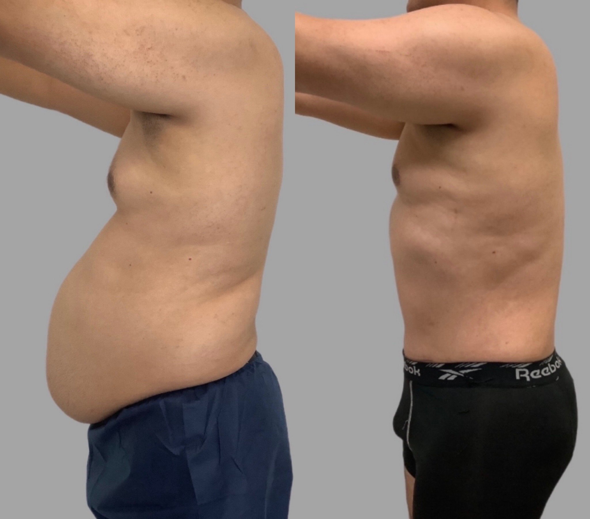 Tummy Tuck + 360 Liposuction