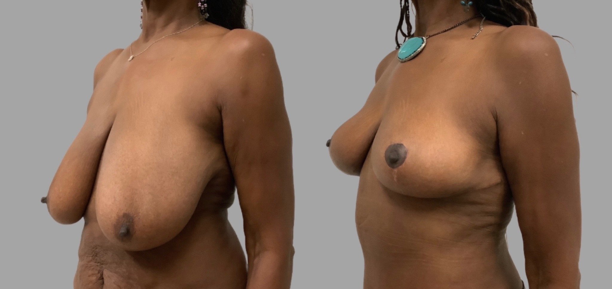 Breast Lift + Tummy Tuck