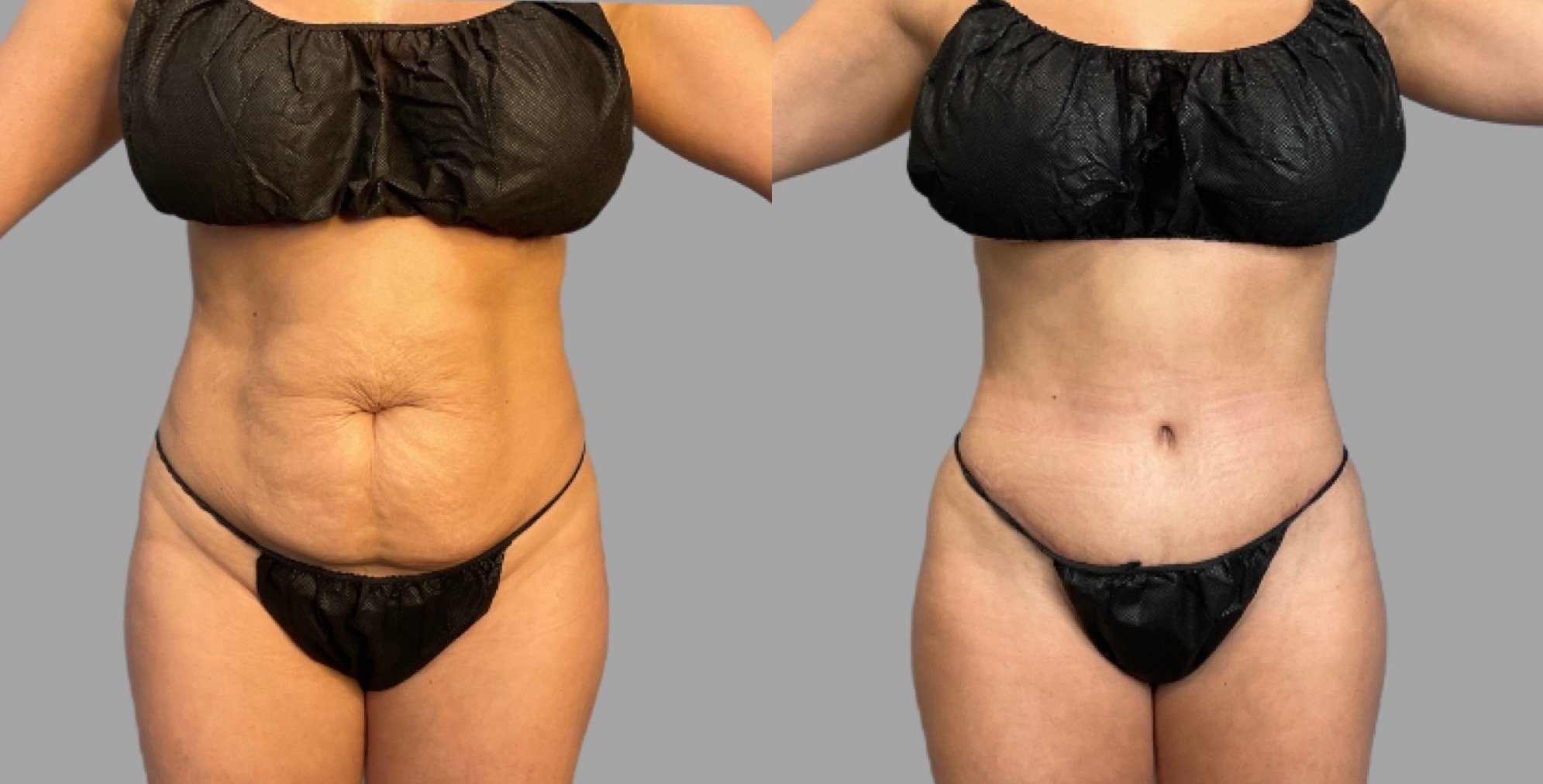 Tummy Tuck + 360 Liposuction