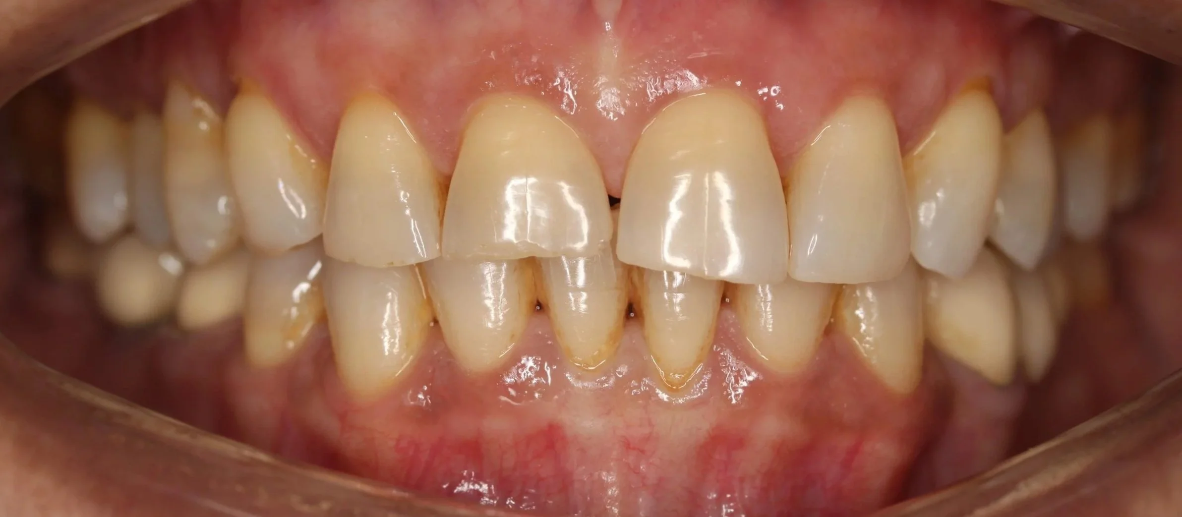 Close-up of a person's upper and lower teeth, showing some crowding and yellowing, with gums visible behind the teeth.