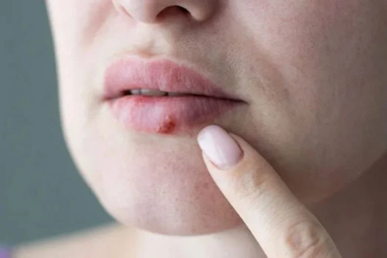 Canker Sores vs Cold Sores — Lone Star Smiles