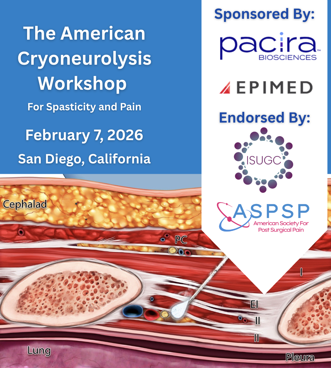 American Cryoneurolysis workshop.png
