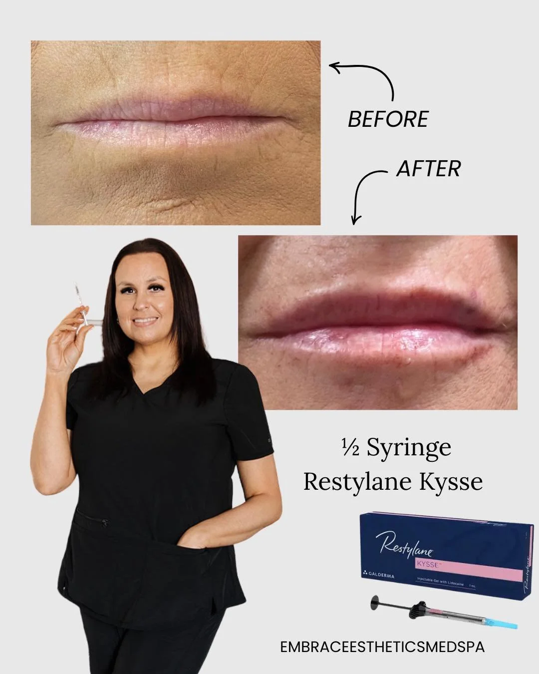 Subtle, hydrated, and beautifully balanced ✨
This lip transformation was done with &frac12; syringe of Restylane Kysse, designed to enhance natural shape, add softness, and restore hydration &mdash; not overfill.

Huge shoutout to Jennifer (Skin by J