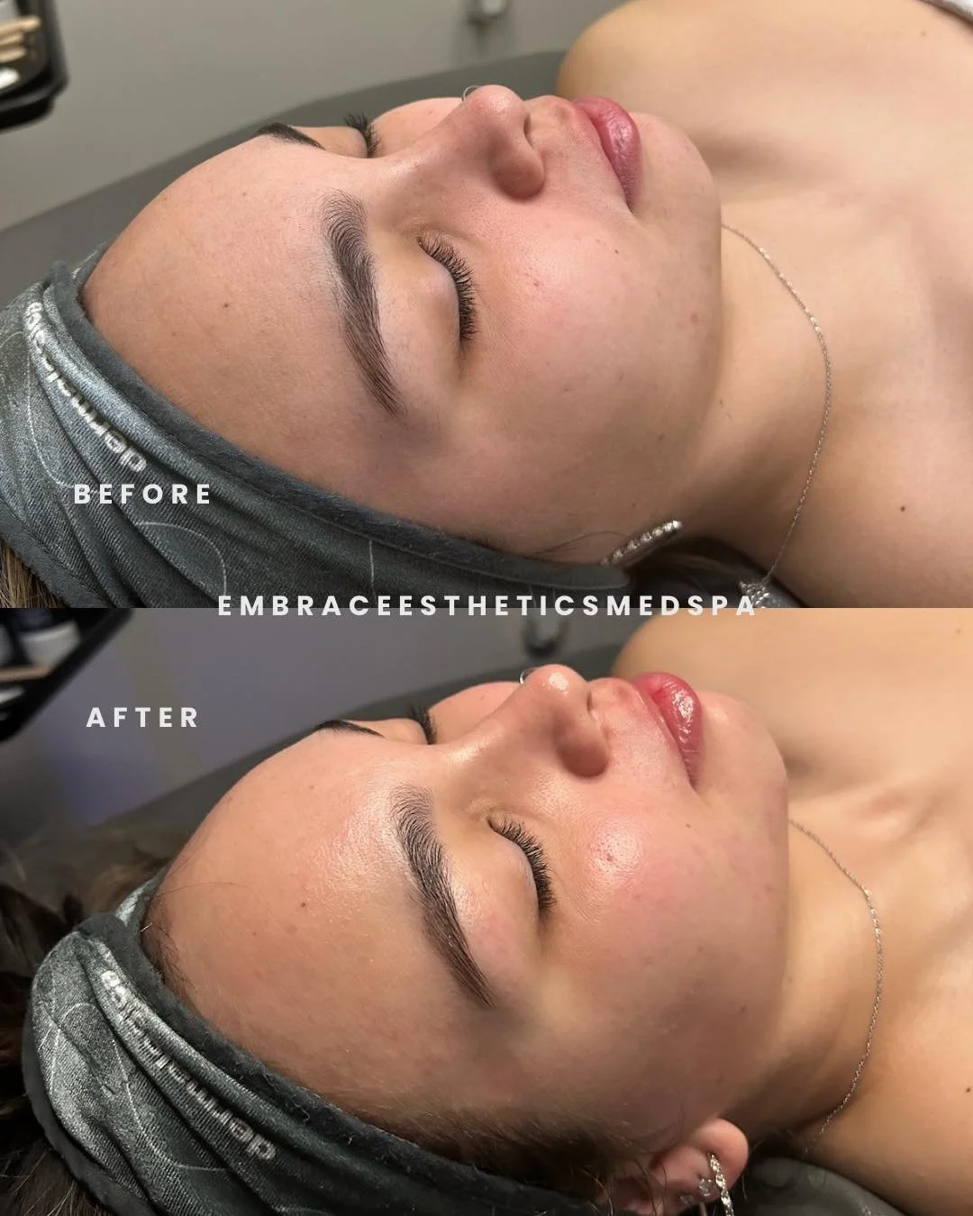Our amazing and knowledgeable esthetician Nicole ( @emerald.estheticsss ) has done it again with these beautiful results. Her clients concerns were dullness and dehydration. To which she then executed a relaxing and results driven experience! Our Pro