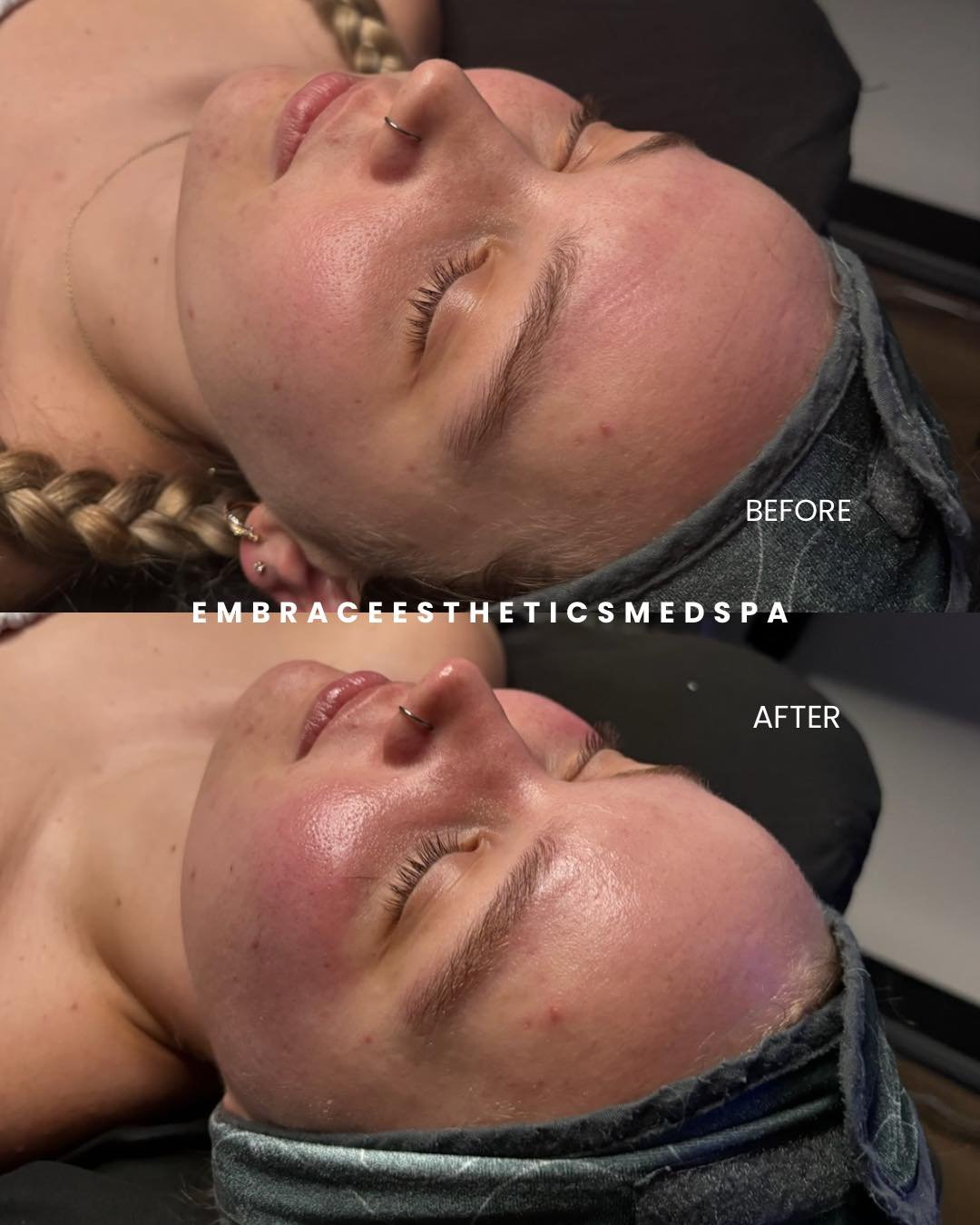 This is what a professional peel with Nicole ( @emerald.esthetics.co ) can do when it&rsquo;s done correctly and paired with the right home care. We&rsquo;re targeting texture, dullness, congestion, and uneven tone at the source&hellip; not just mask