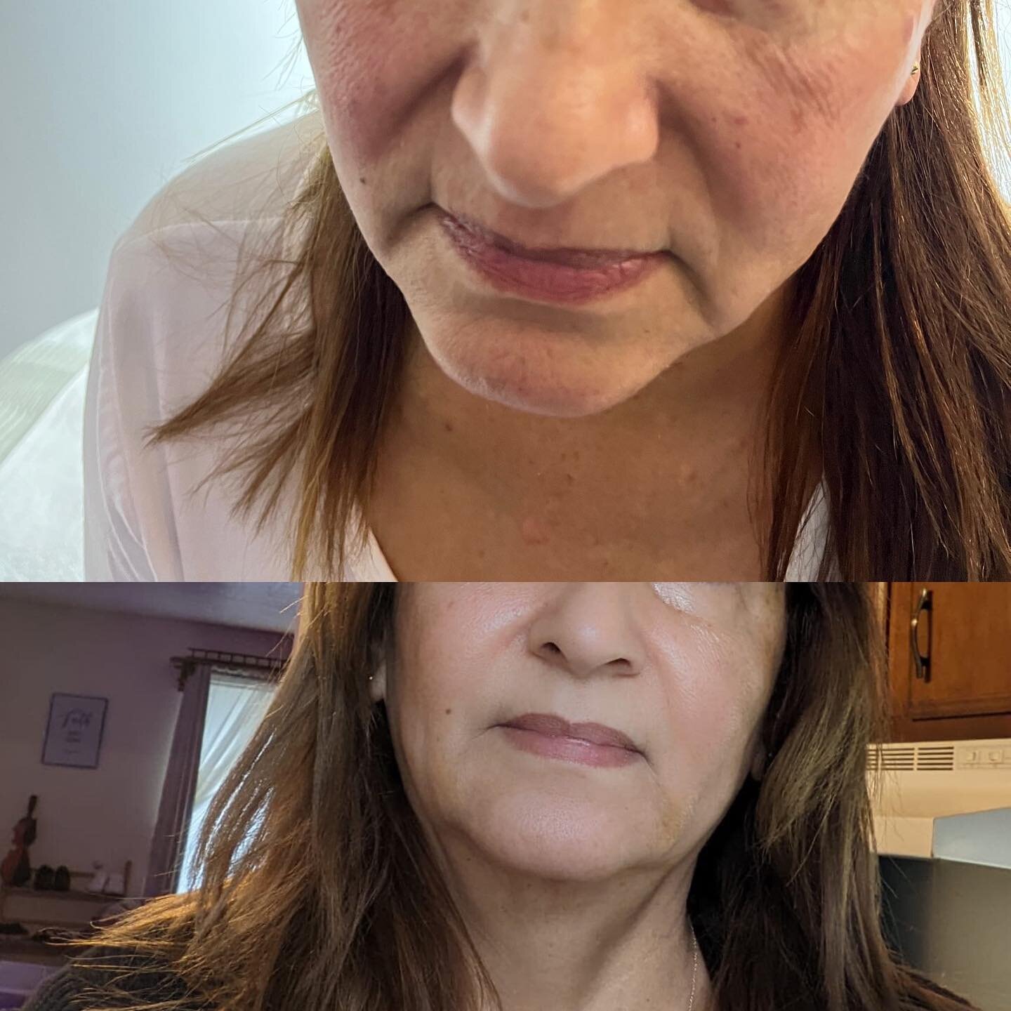 Is hyaluronic acid good for anti-aging?
Hyaluronic acid has beneficial properties when used on your skin. It's especially useful for reducing the appearance of wrinkles and age lines.#womensupportingwomen #mujeremprendedora#mujerbonita#hackensacknj#p