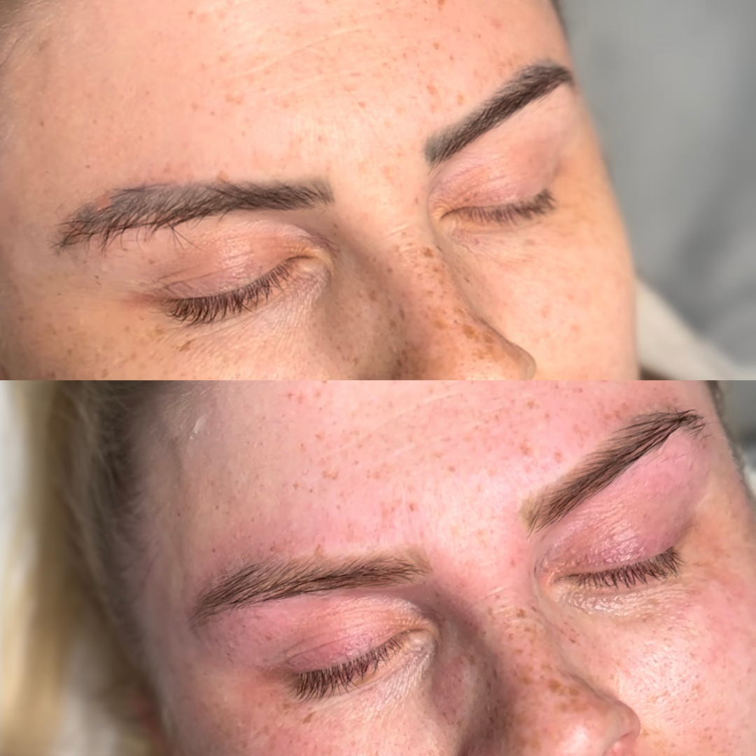 laser removal .png