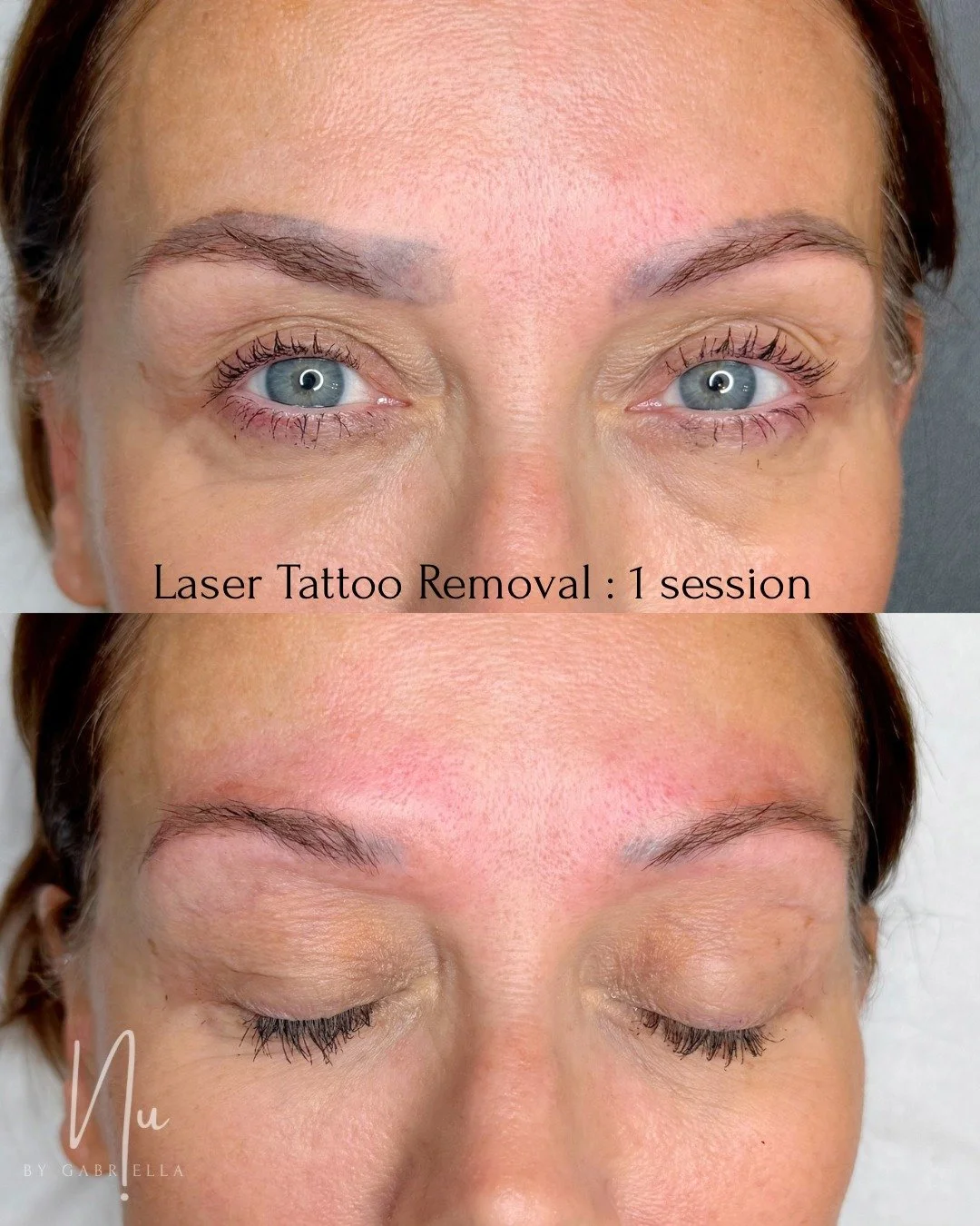 ✨ Laser Tattoo Removal: What You Need to Know ✨

Here&rsquo;s a great example from one of my clients: she wanted a fresh set of combination brows, but the old PMU underneath wasn&rsquo;t symmetrical and had healed into mixed tones. In cases like this