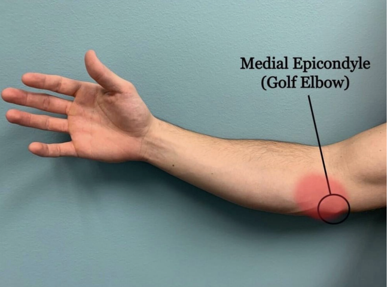 What to do about Golfer’s Elbow