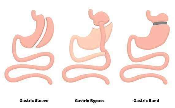 Weight Loss Surgery Types