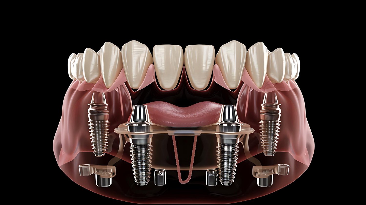 Implants vs Dentures: Which Tooth Replacement Option Is Right for You?
