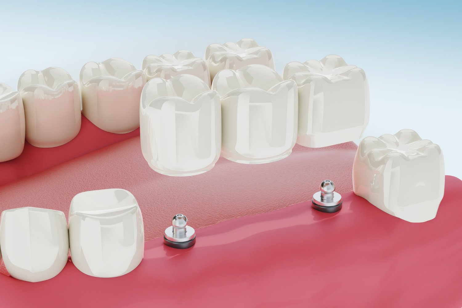 What Are Dental Implants and How Do They Replace Missing Teeth?