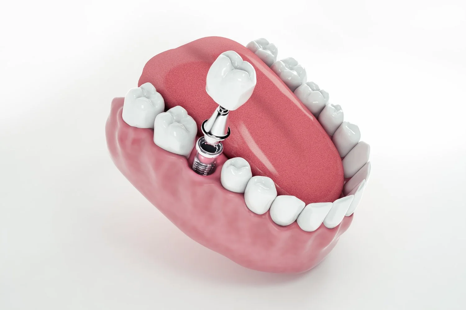 Are Dental Implants Covered by Medicare or Health Insurance?