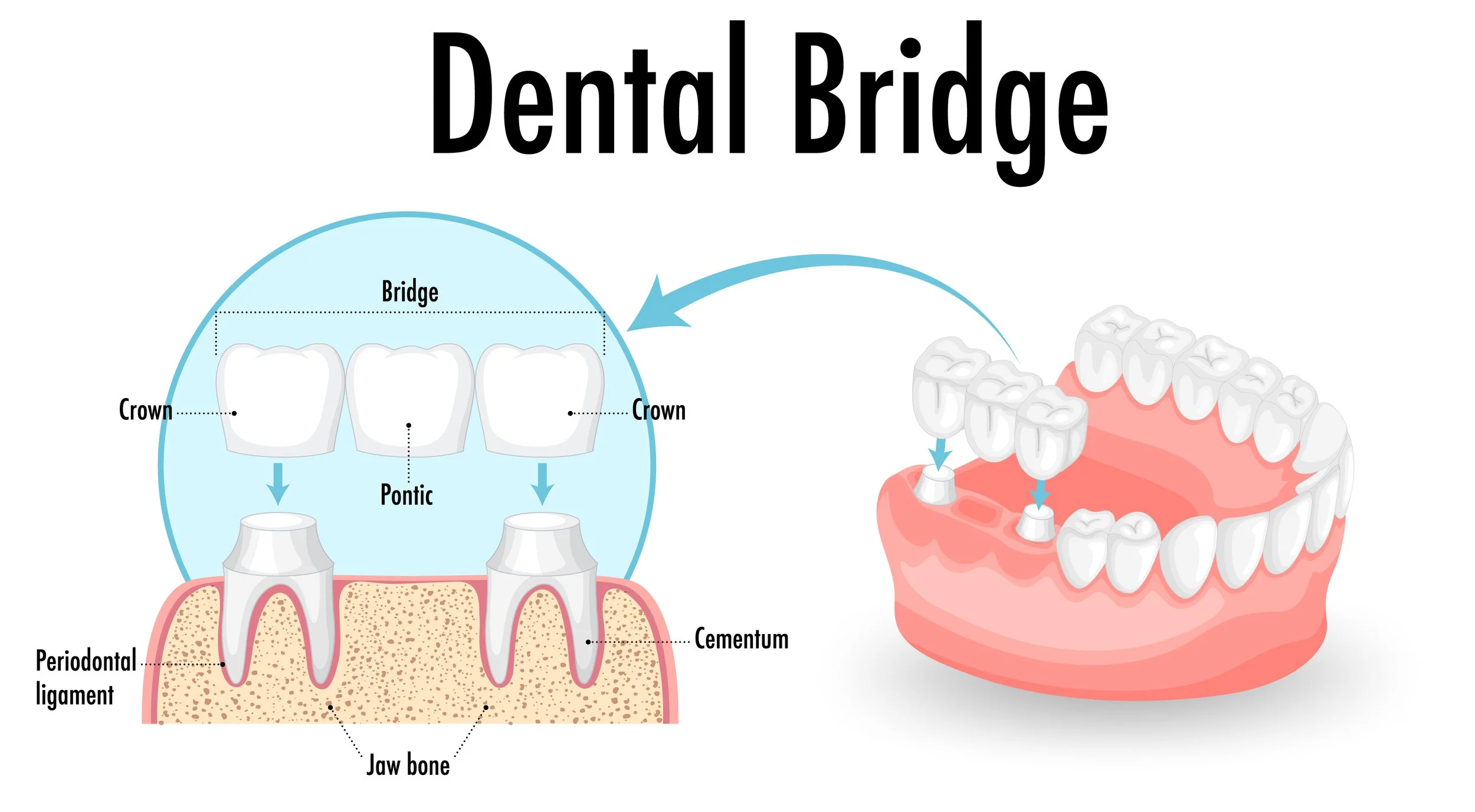 What Makes a Dental Bridge a Reliable Solution for Missing Teeth?