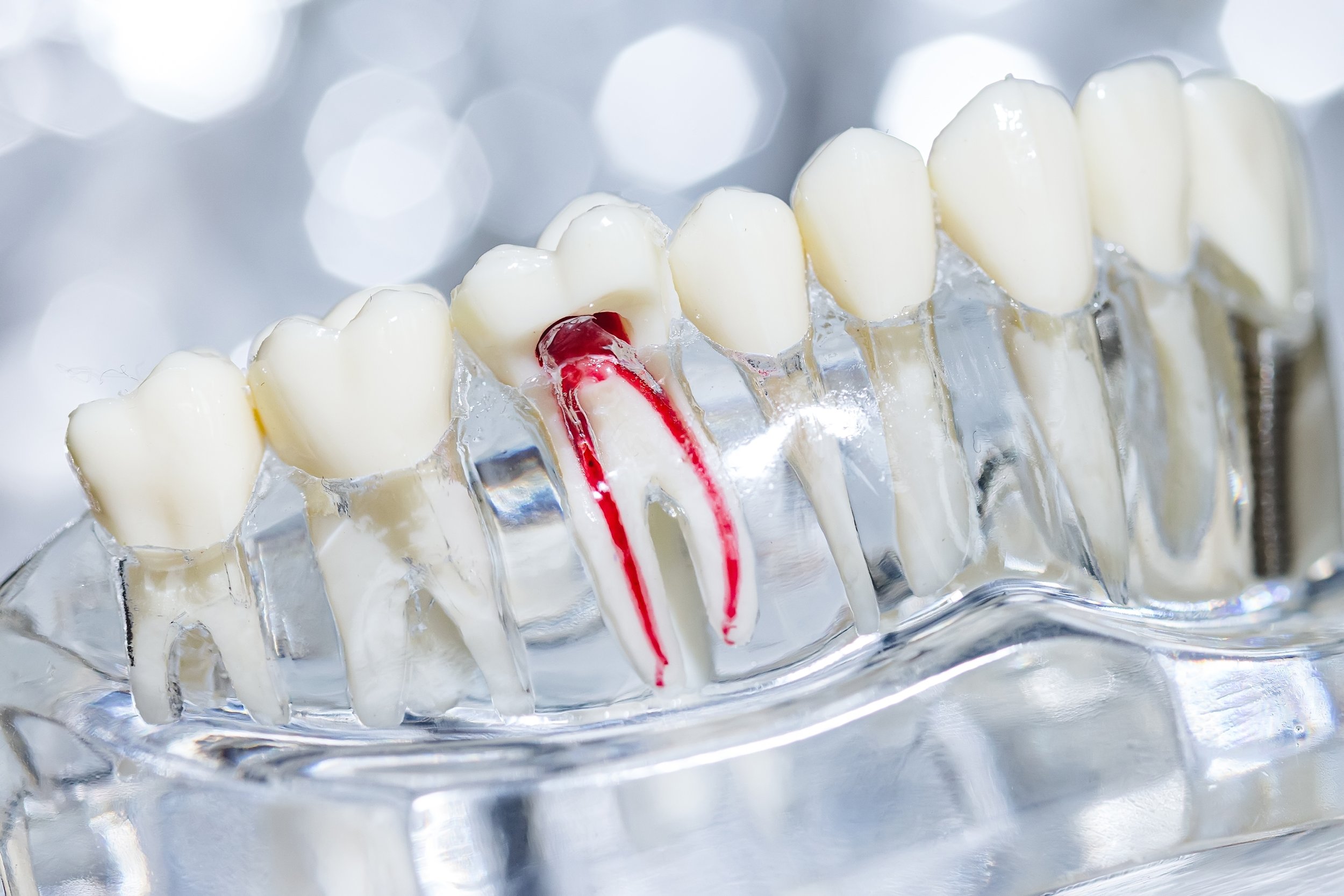 Root Canal or Pull It Out? How to Weigh the Choice 