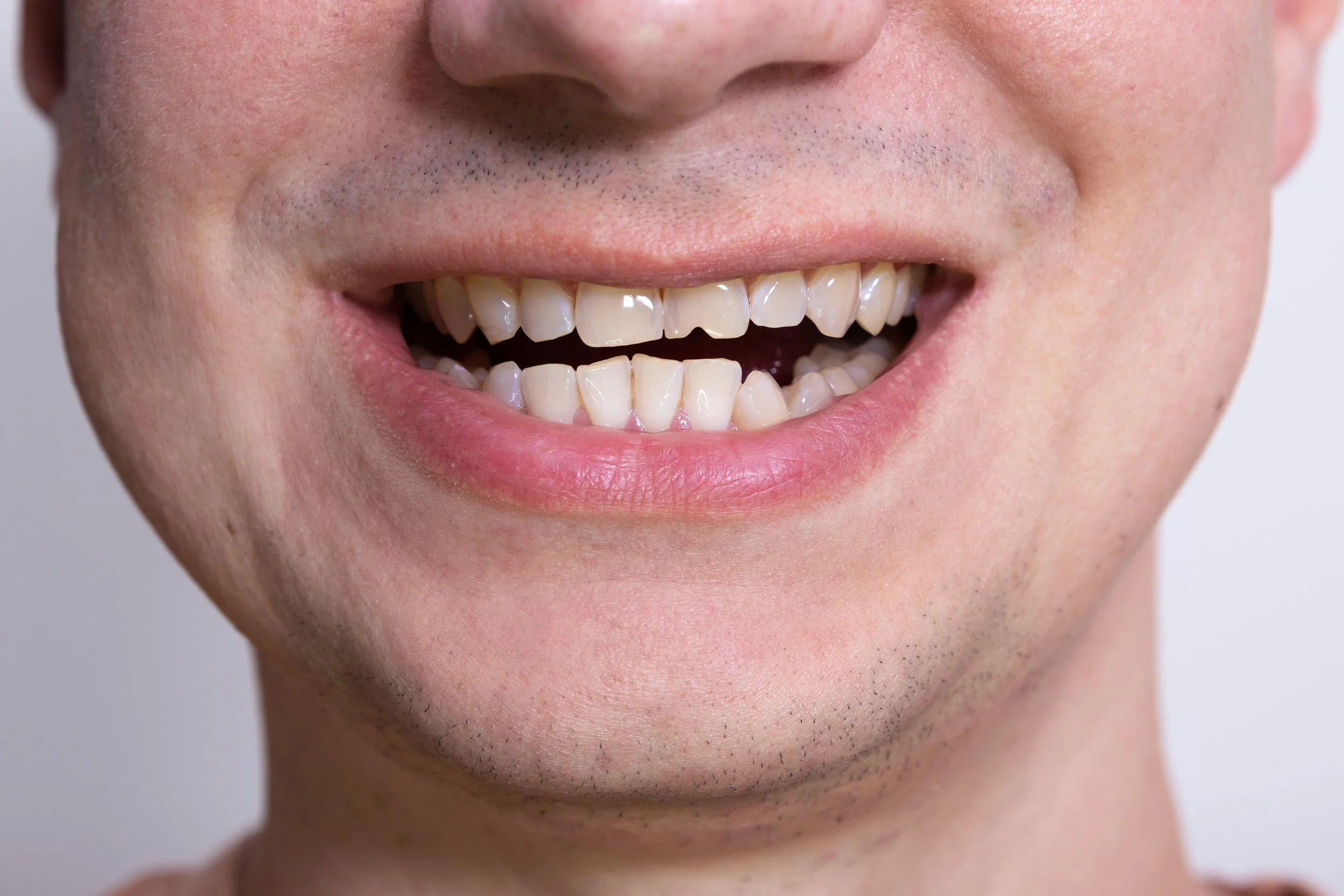 Chipped a Front Tooth? Your Options for Fixing It 