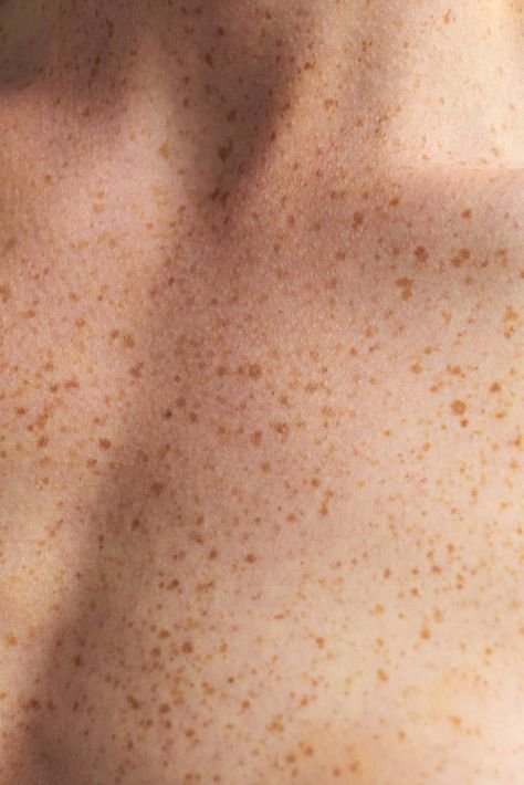 freckles.jpeg