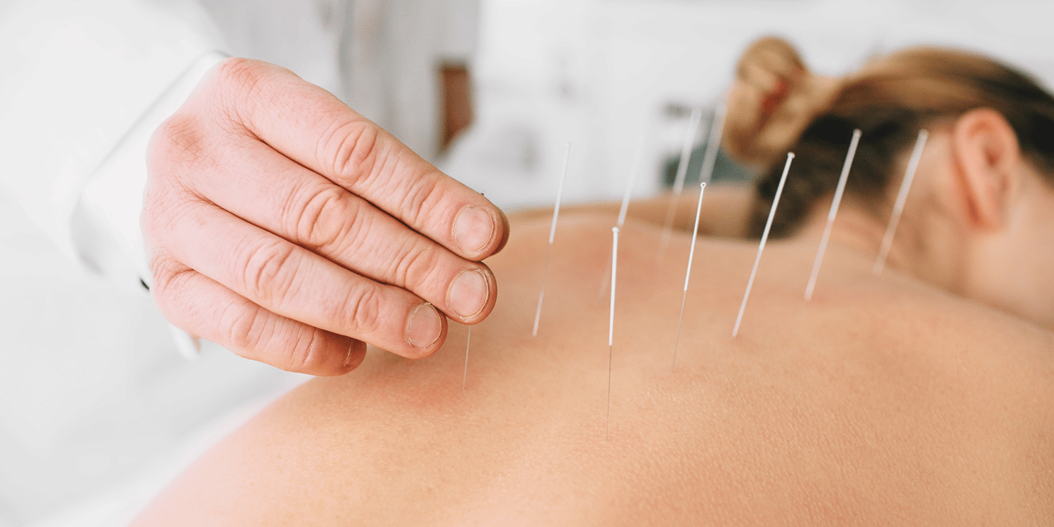 ACUPUNCTURE — Brixton Chiropractic & Acupuncture