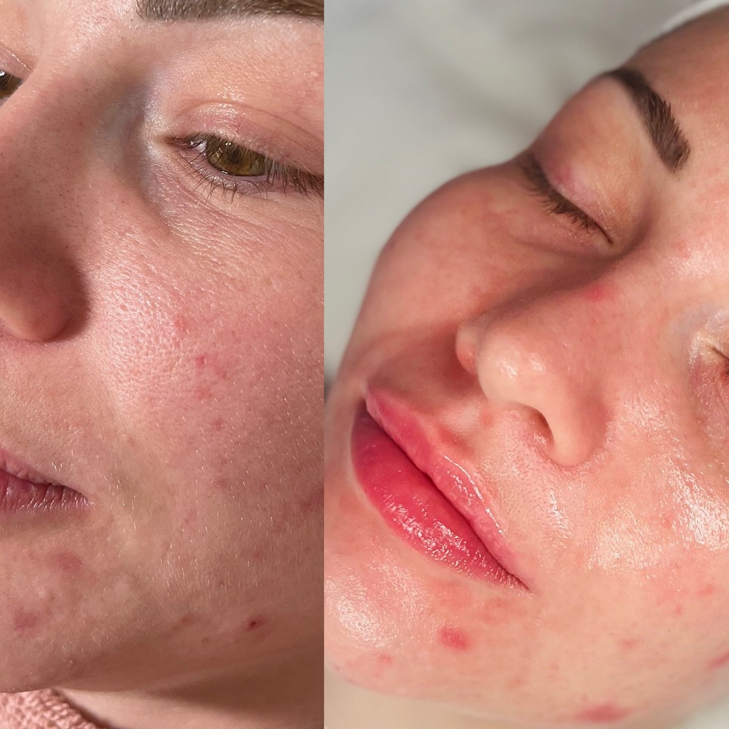 Skin Care Journey: From Inflamed to Glowing!

When my lovely client first came to me, they were experiencing:

 &bull; Inflamed skin
 &bull; Acne breakouts
 &bull; Dehydrated, unbalanced skin

We created a tailored treatment plan focusing on healing,