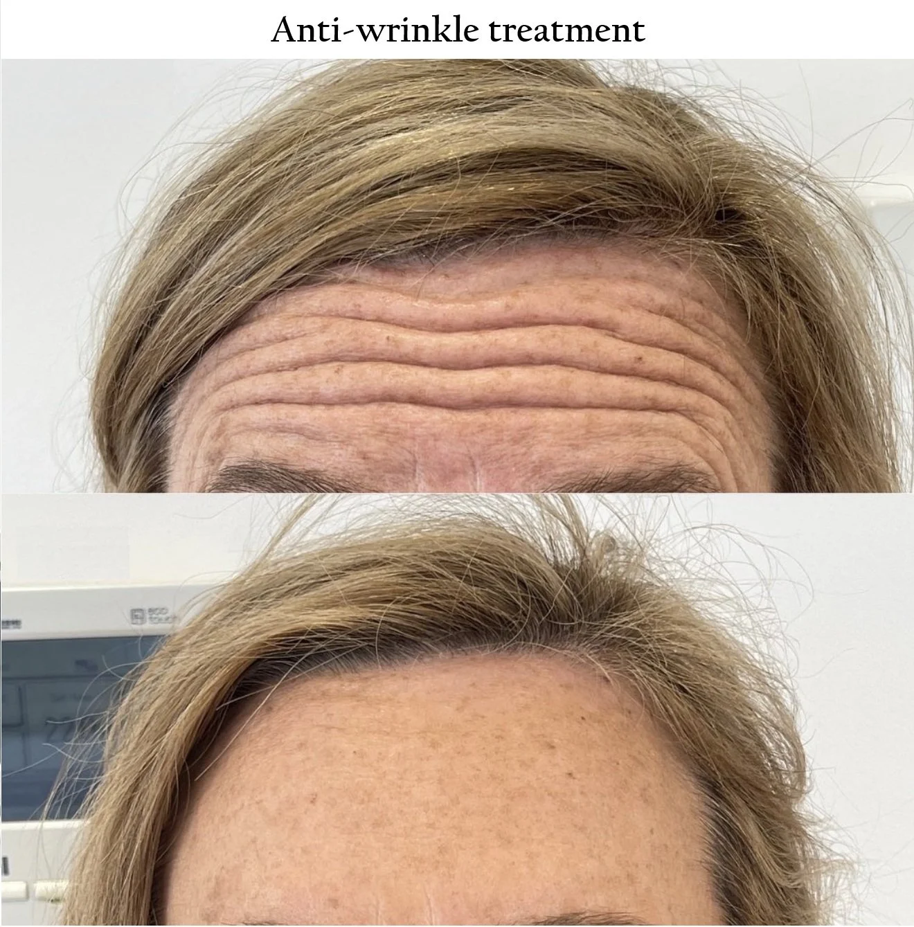 Anti-wrinkle.jpg