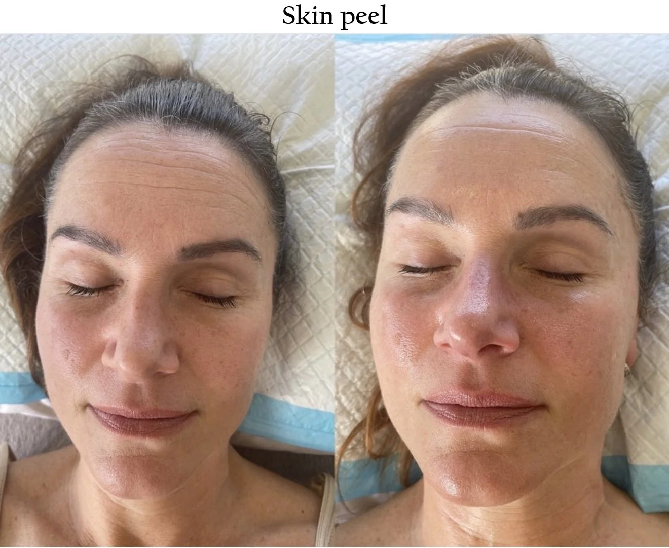 Skin peel.jpg