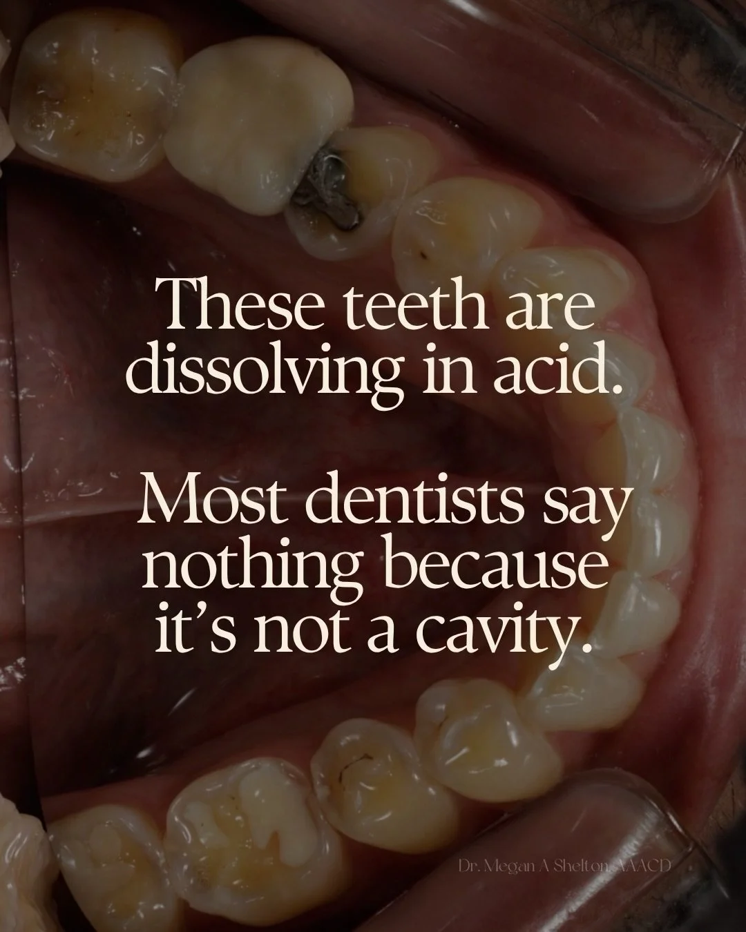 This patient was in their early 30s. No giant cavities. No dramatic chief complaint. But the teeth were actively dissolving in an acidic environment.

And this is where many dentists struggle. Not because they are bad doctors. Because we were trained