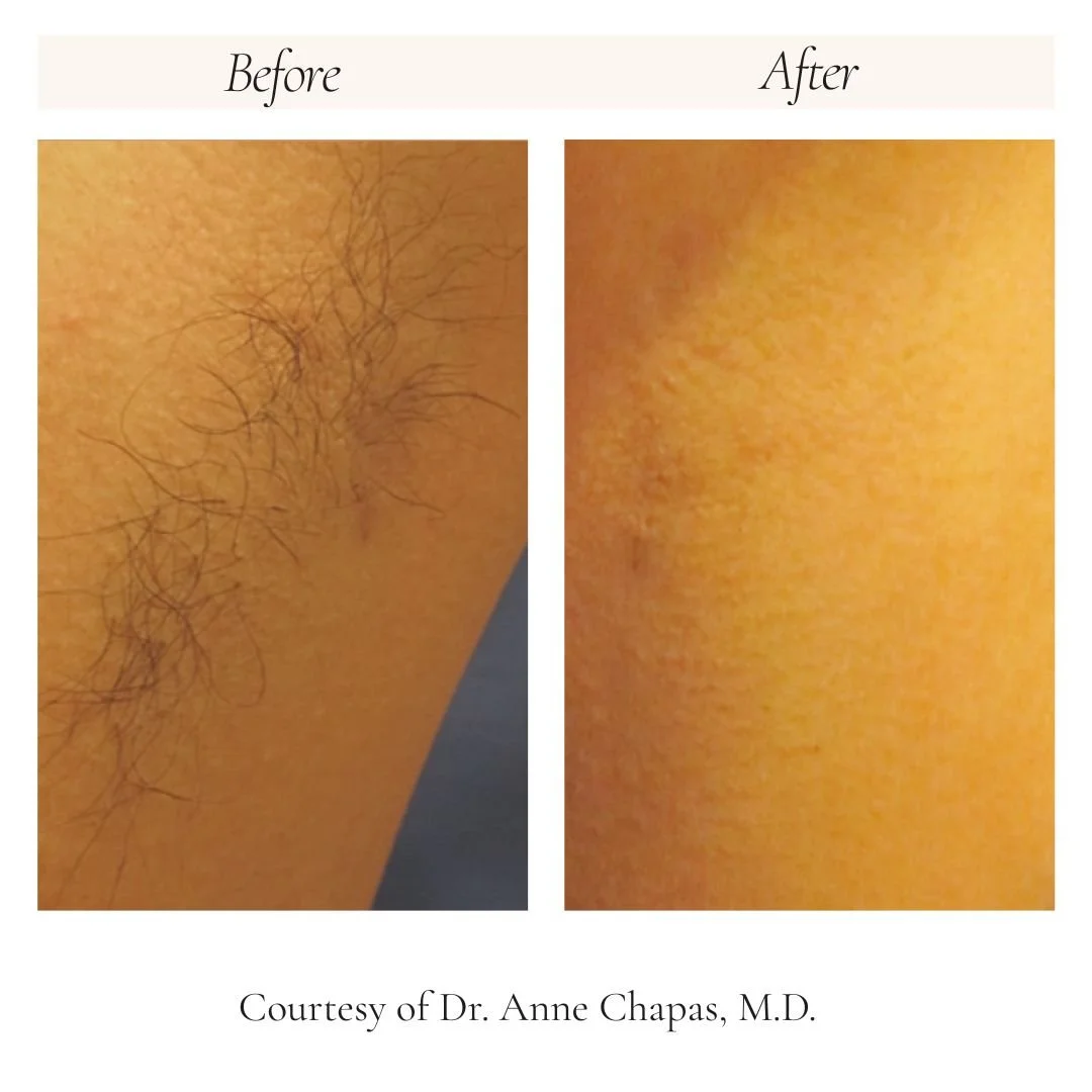 splendor-x-2.0-armpit-hair-removal-before-after.jpg