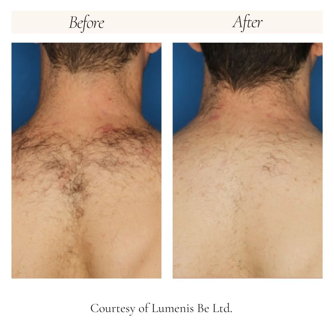 splendor-x-2.0-back-hair-removal-before-after.jpg