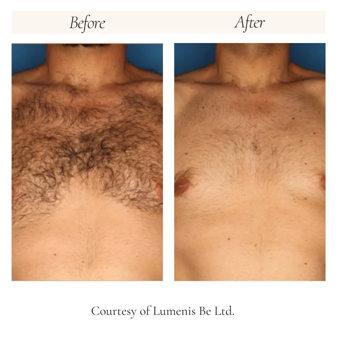 splendor-x-2.0-chest-hair-removal-before-after.jpg