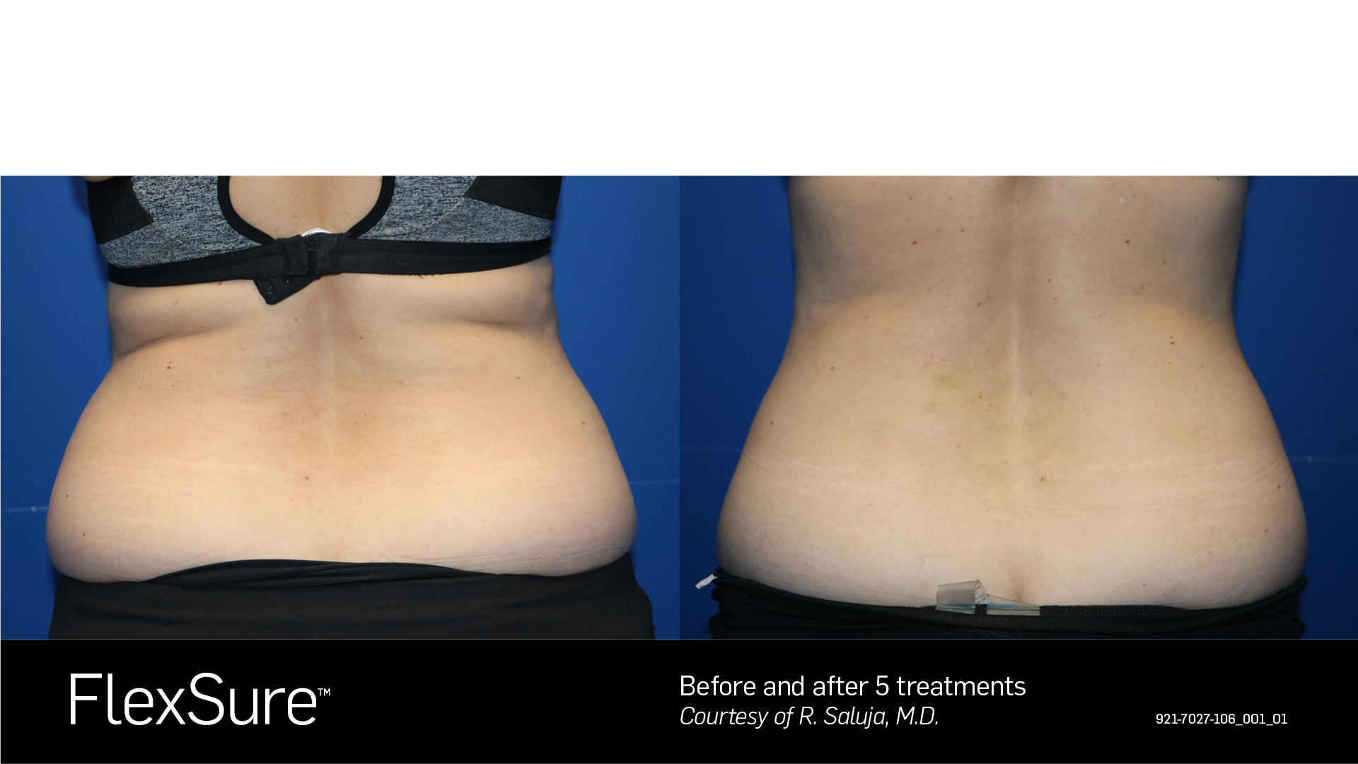 Comparison of a person's lower back before and after five FlexSure treatments showing reduced fat and contour improvement.