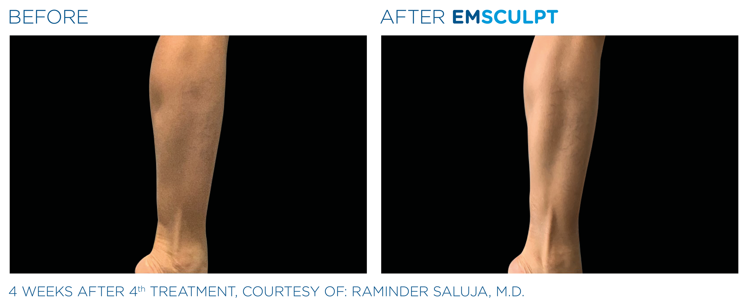 Comparison of a person's leg before and after EMSCULPT treatment showing reduced skin laxity and improved skin tone.