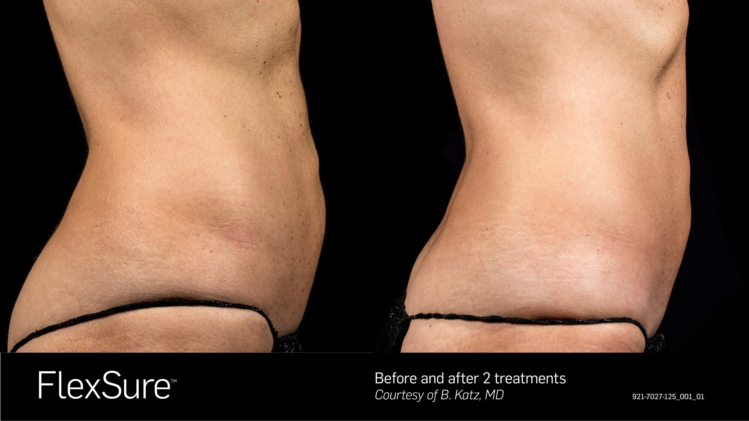 Side-by-side comparison of a woman's midsection before and after two treatments of FlexSure, showing improved skin tightness and smoothness.