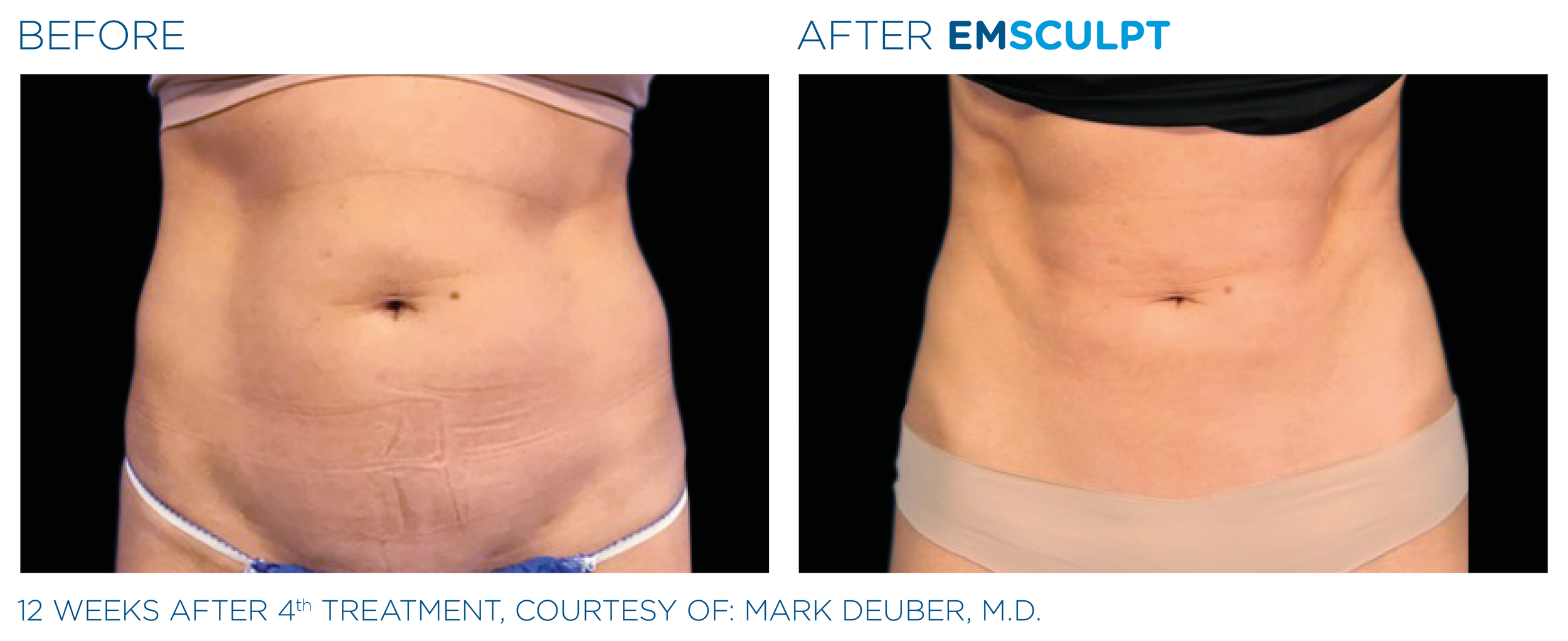 Before and after images of a woman's abdomen showing improved skin tightness and reduced stretch marks after EMSCULPT treatment.