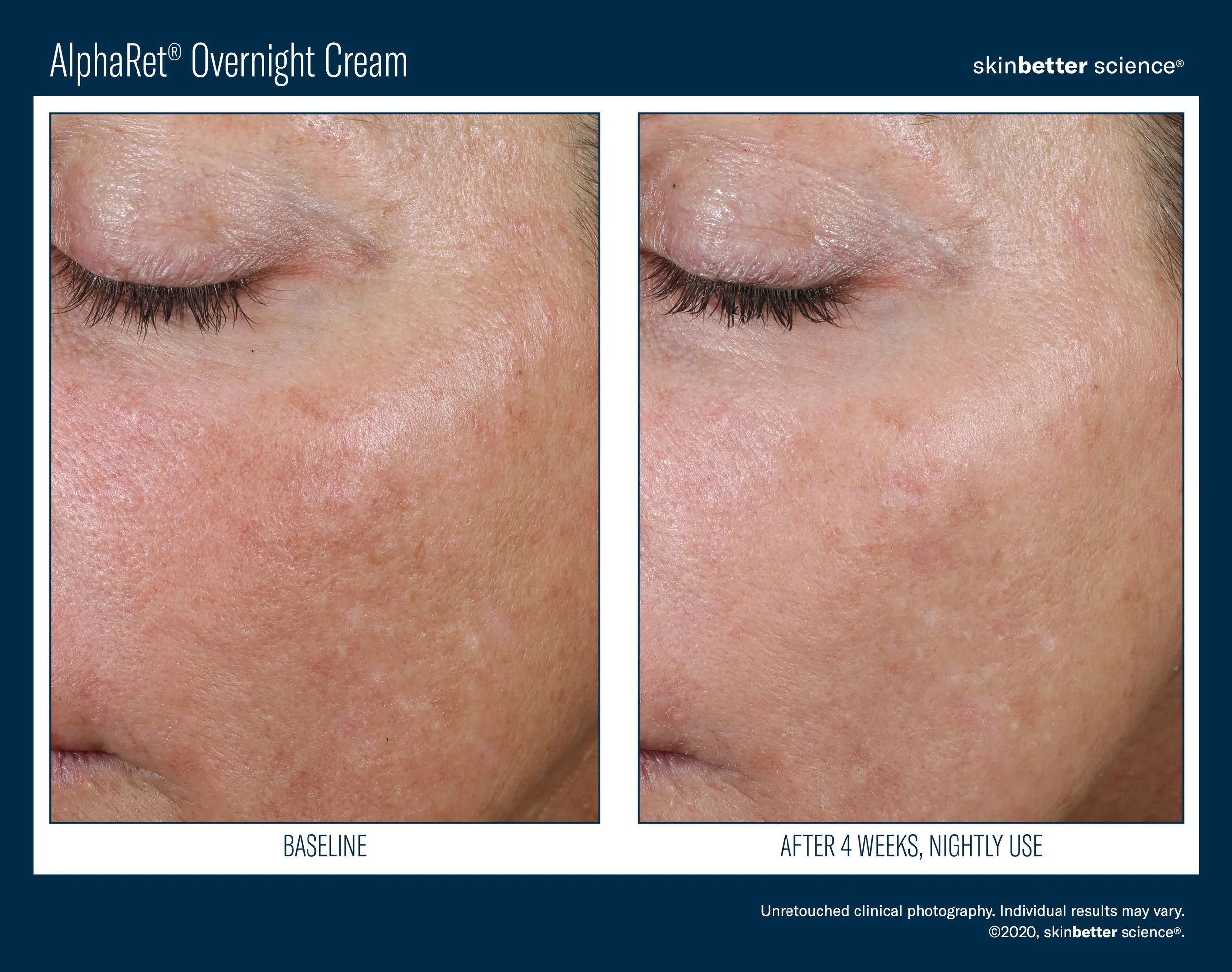 Side-by-side comparison of a woman's cheek before and after 4 weeks of overnight use of AlphaRet® Overnight Cream, showing improved skin texture and reduced discoloration.