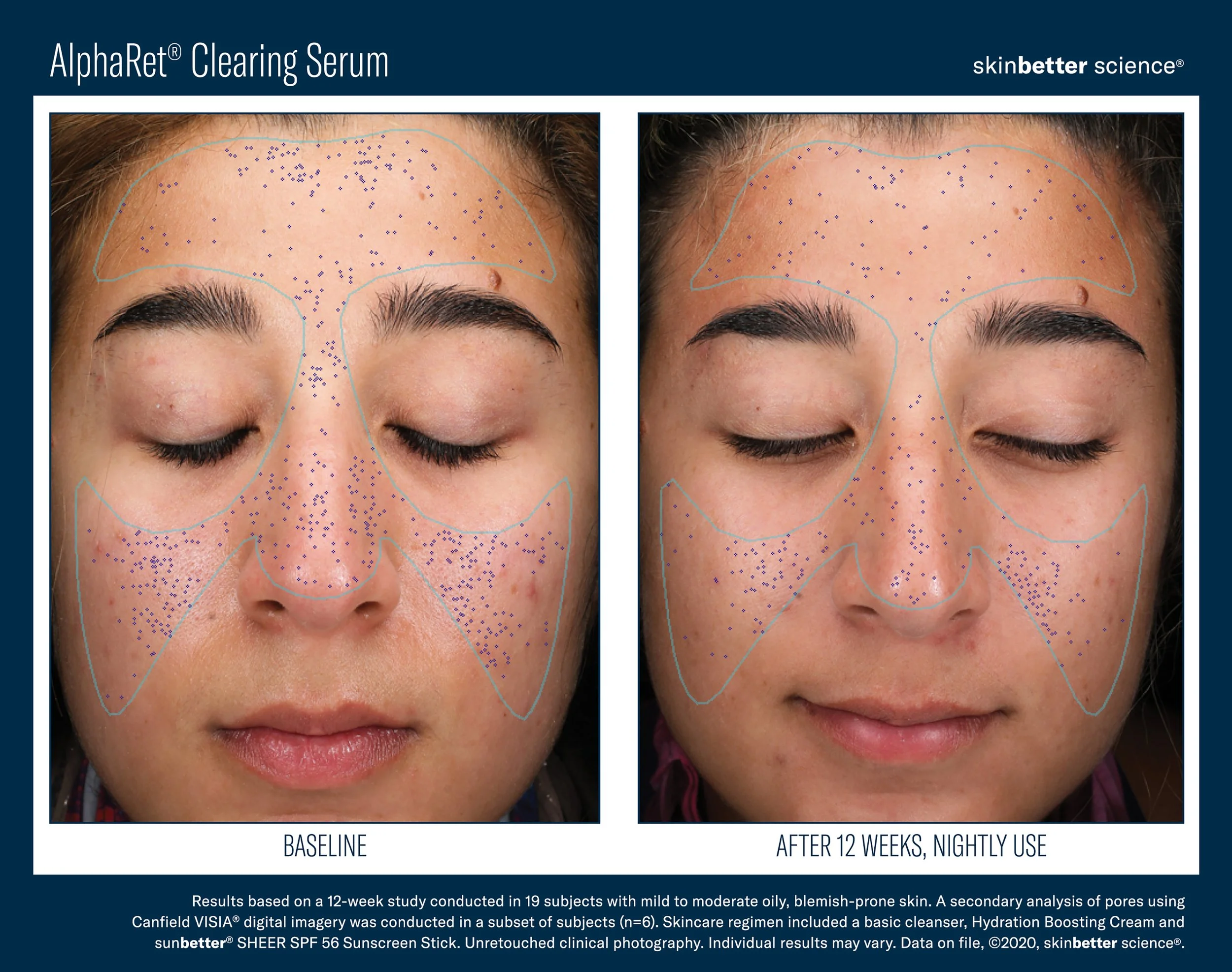 Comparison of a woman's face before and after 12 weeks of using AlphaRet Clearing Serum, showing decreased blemishes and improved skin texture.