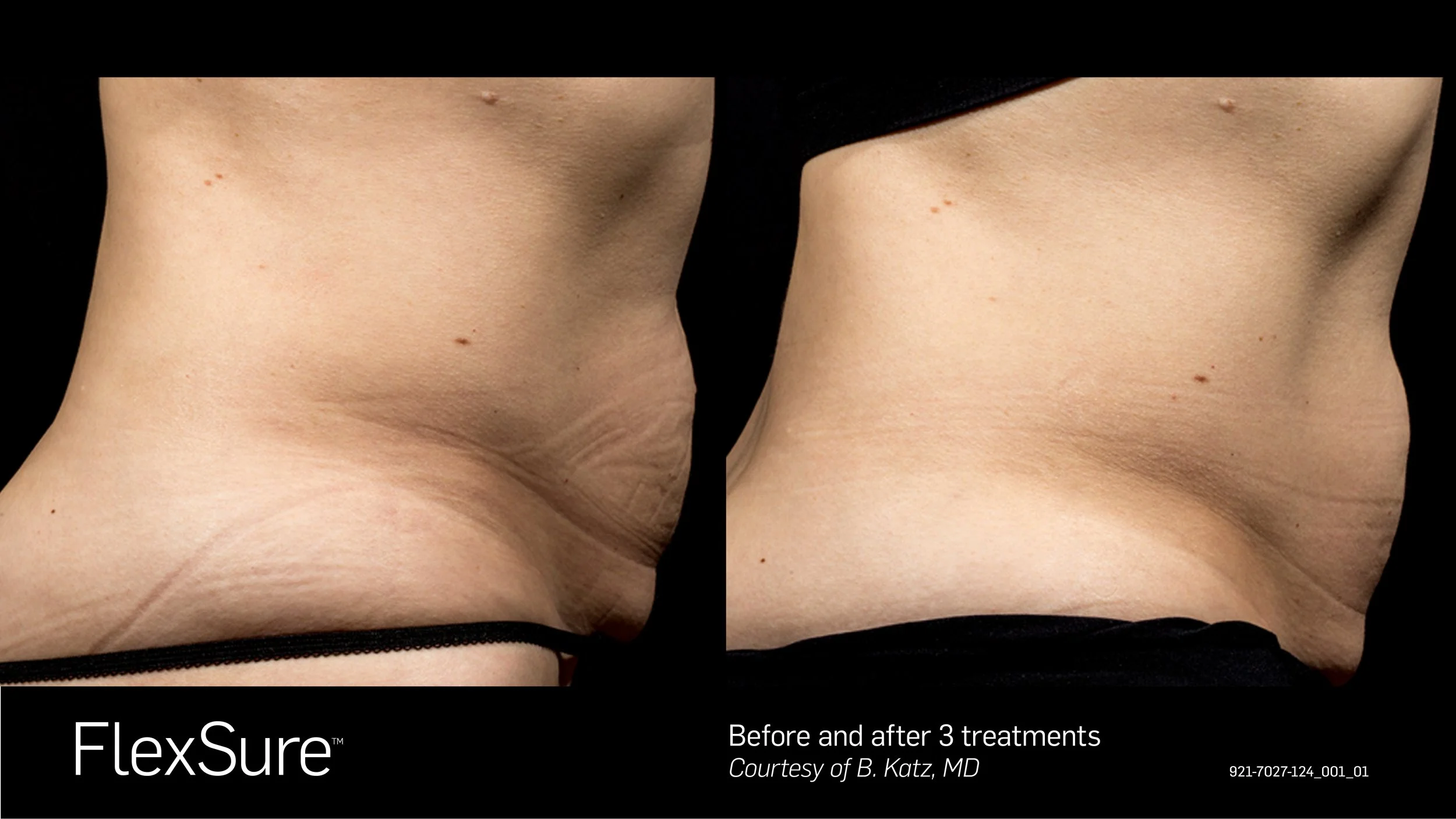 Side-by-side comparison of a person's abdomen before and after three treatments with FlexSure, showing reduced skin laxity and improved skin appearance.