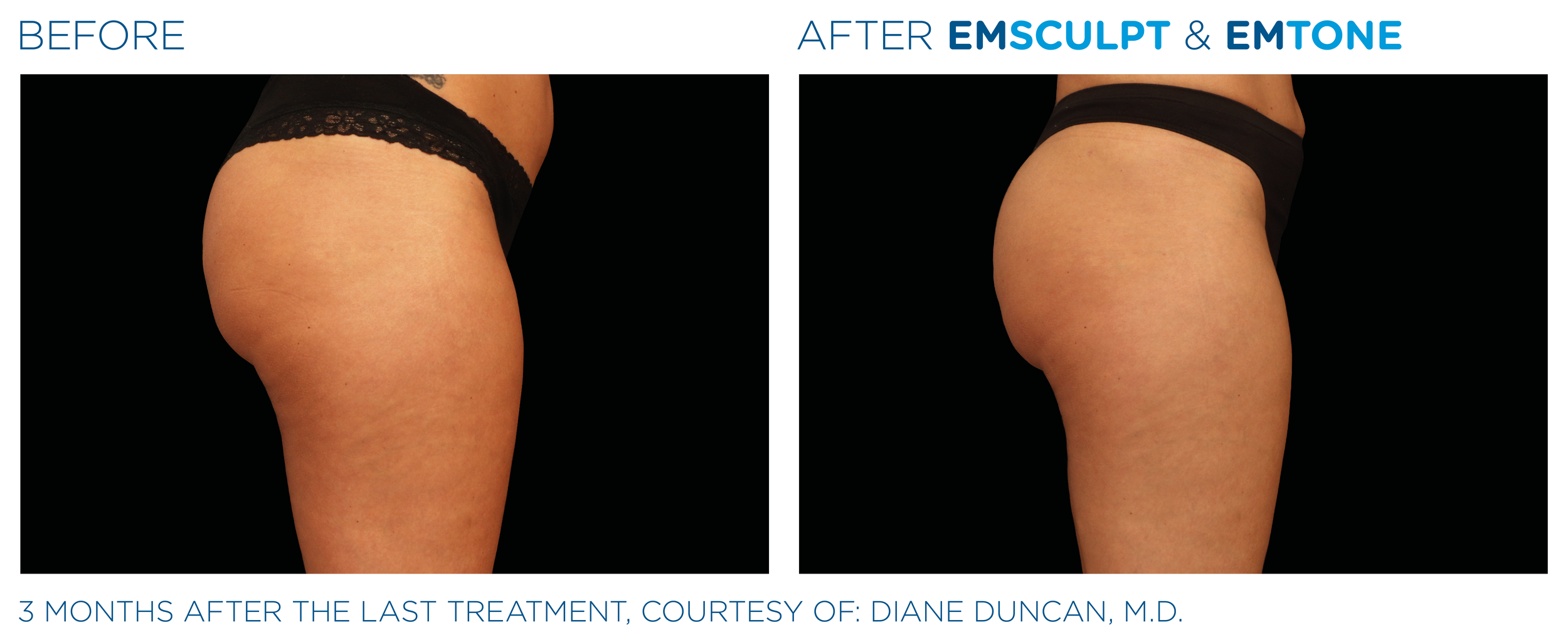 Side-by-side comparison of a woman's buttocks before and after cosmetic treatment. The left image shows the 'before' state, and the right image shows the 'after' results following EMSCULPT and EMtone procedures, with a noticeable improvement in conto
