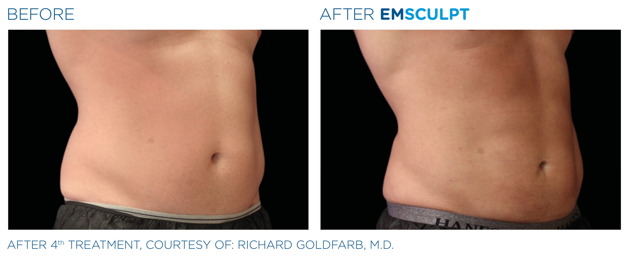 Comparison of a person's abdomen before and after EMSCULPT treatments, showing reduced fat and improved muscle tone.