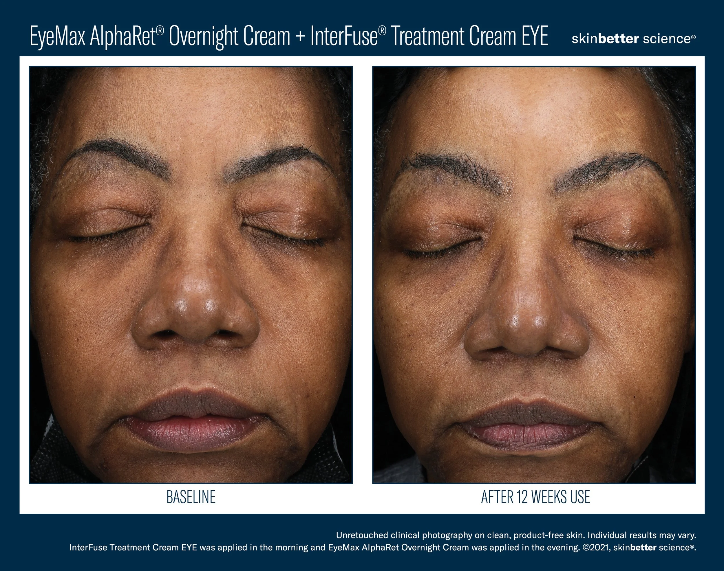 Comparison of a woman's face showing skin condition before and after 12 weeks of treatment, with improved skin texture and appearance.